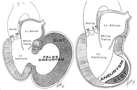 lv aneurysm sheme|Aneurysm and pseudoaneurysm of the left ventricle .